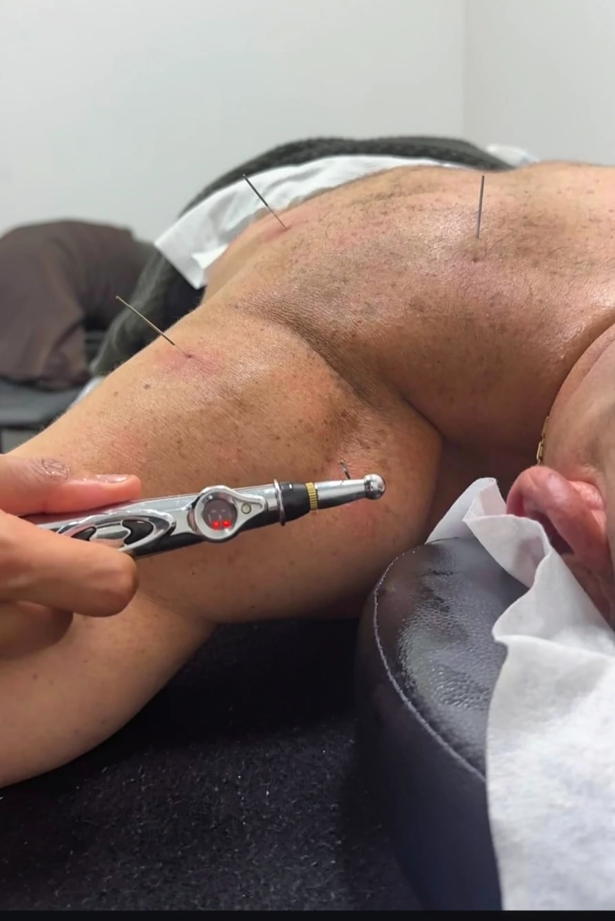 Dry Needling (Agulhamento a Seco)