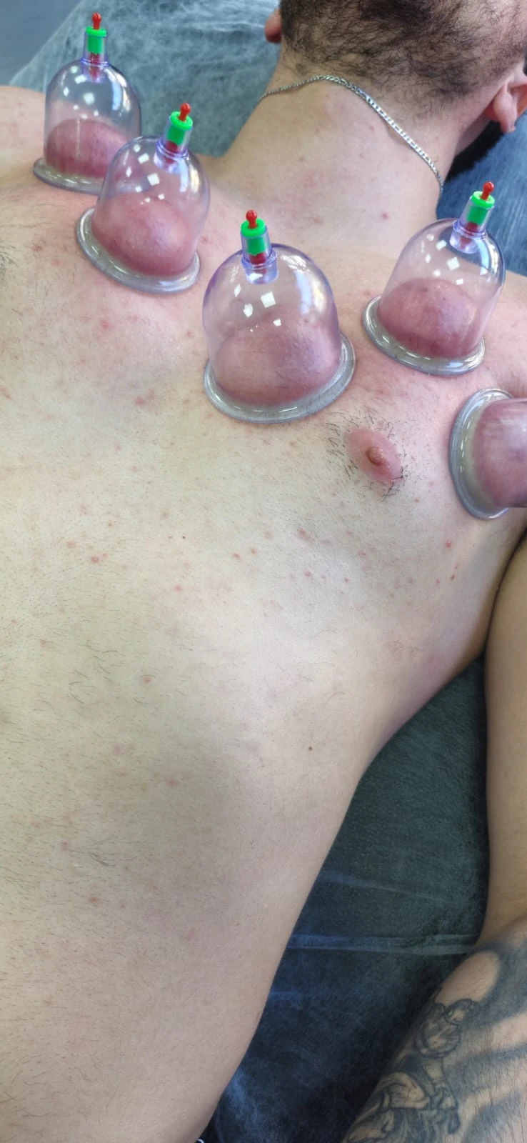Ventosaterapia